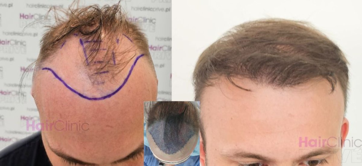 Resultados de trasplante capilar antes y después en HairClinic – línea capilar restaurada