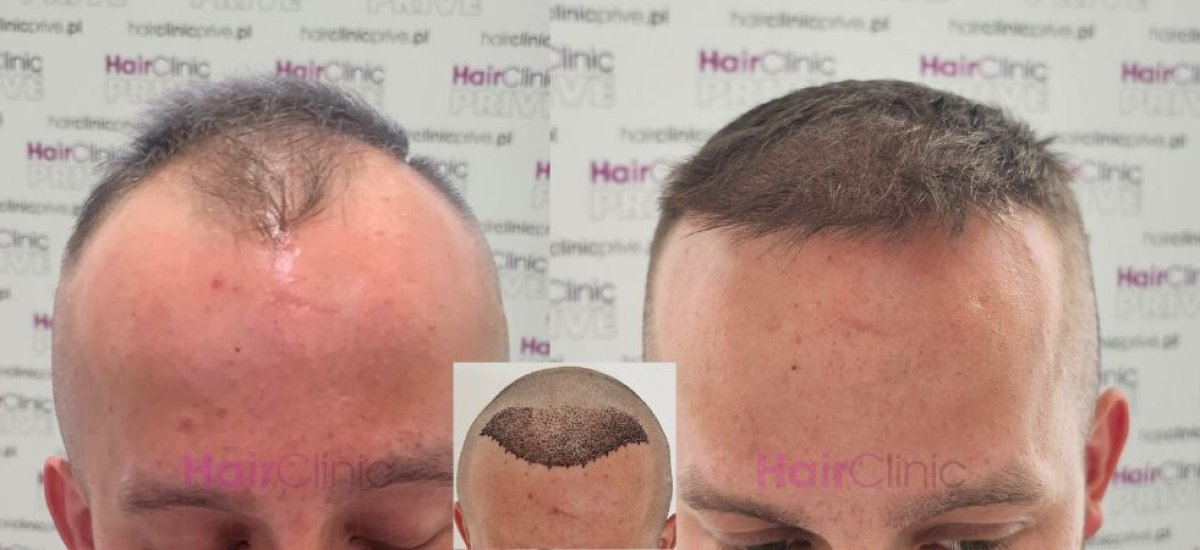 نتائج زراعة الشعر قبل وبعد في HairClinic – استعادة خط الشعر وكثافة الشعر