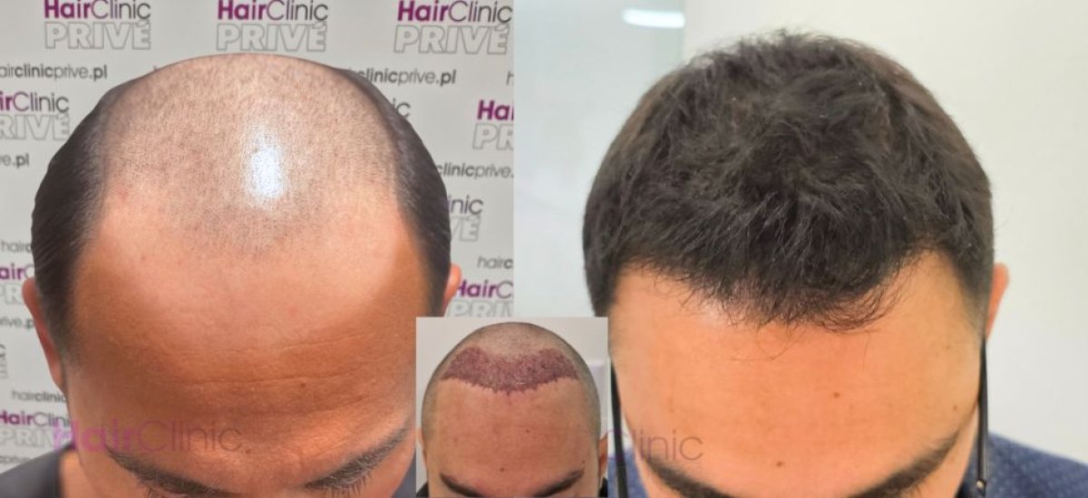 نتائج زراعة الشعر قبل وبعد في HairClinic Prive – استعادة خط وكثافة الشعر