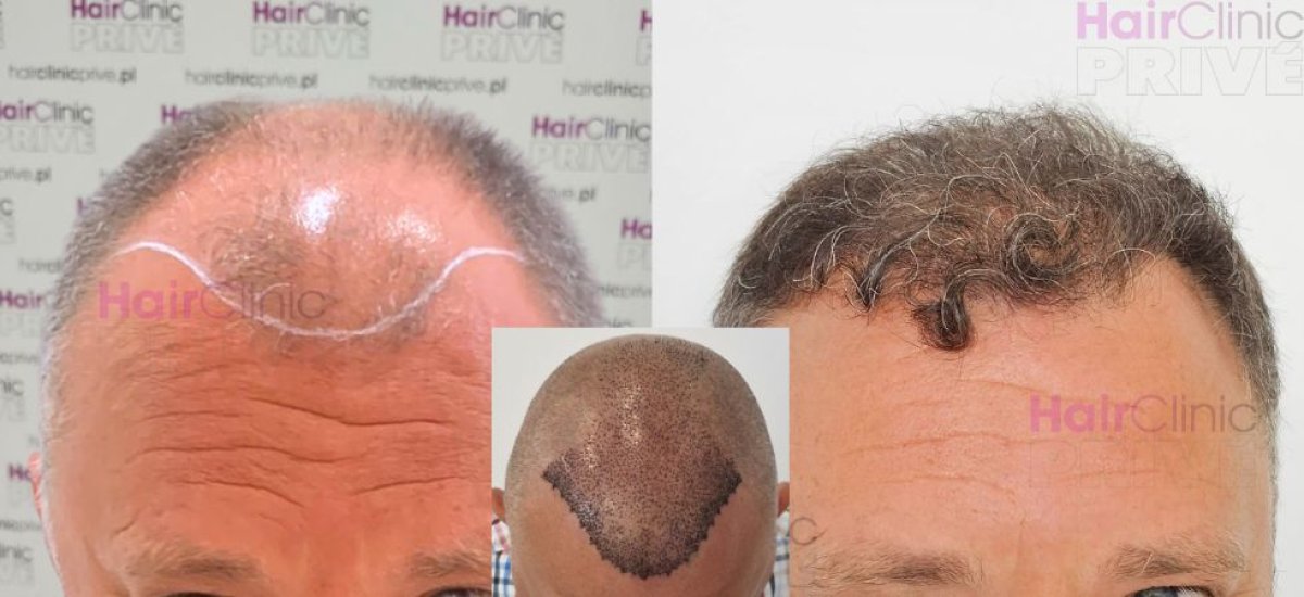 نتائج زراعة الشعر قبل وبعد في HairClinic Prive – استعادة خط الشعر الطبيعي