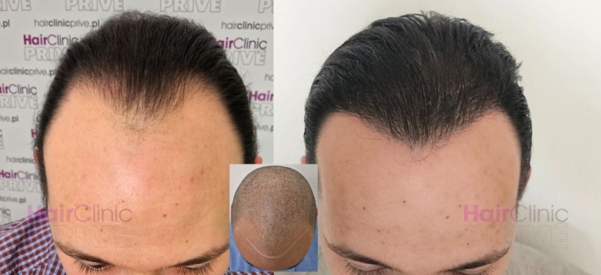 Resultados de trasplante capilar FUE en HairClinic Prive: línea capilar restaurada en hombre