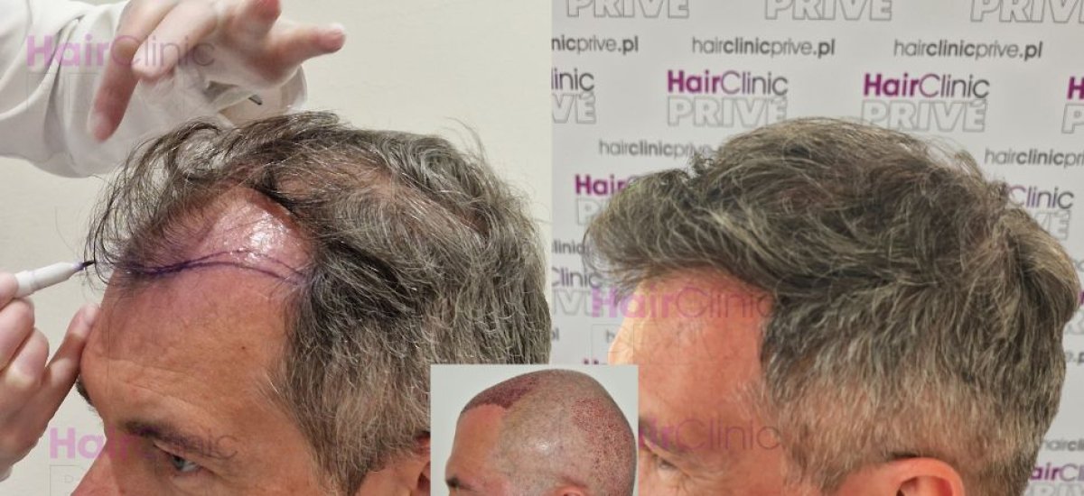 Resultados de trasplante capilar antes y después en HairClinic Prive – línea restaurada