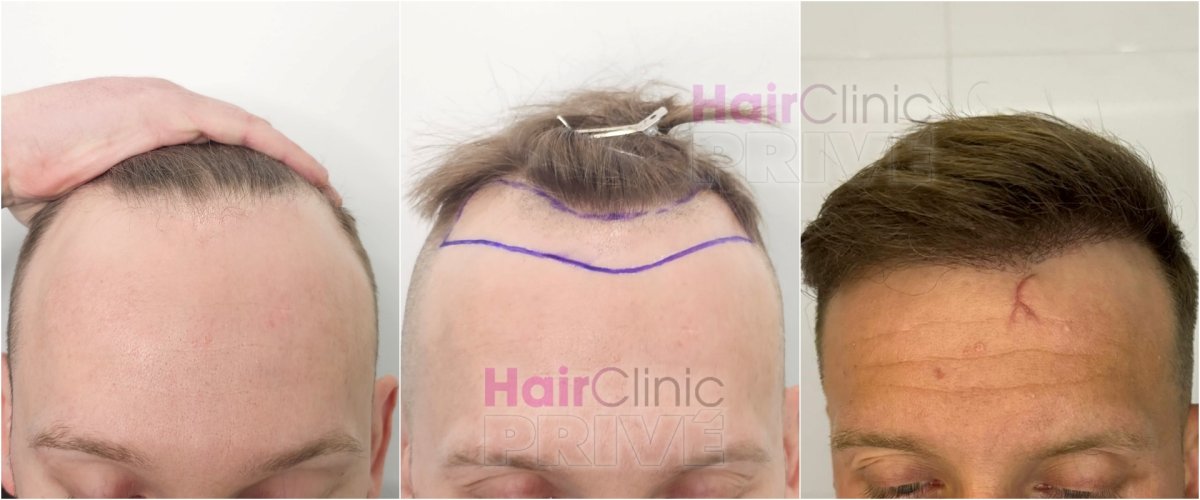 نتيجة زراعة الشعر قبل وبعد في Hair Clinic Privé – استعادة خط الشعر لدى المريض
