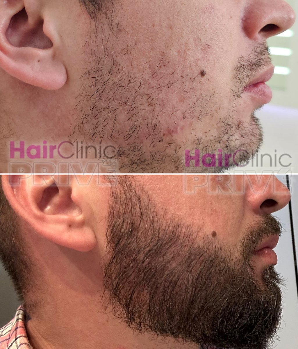 Resultados de trasplante de barba antes y después en Hair Clinic Prive – barba más densa