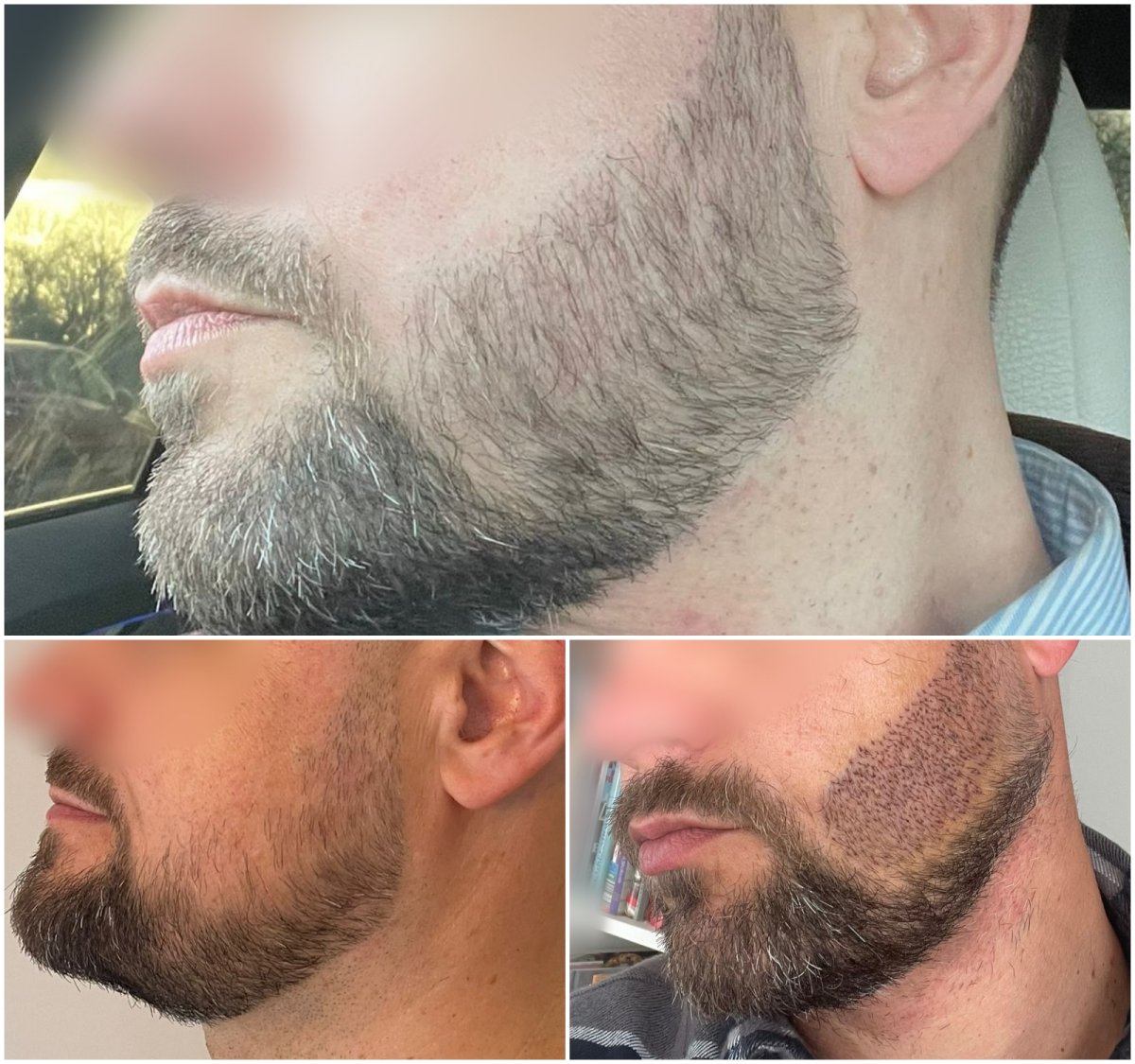 Resultados antes y después de trasplante de barba, restauración de vello facial masculino
