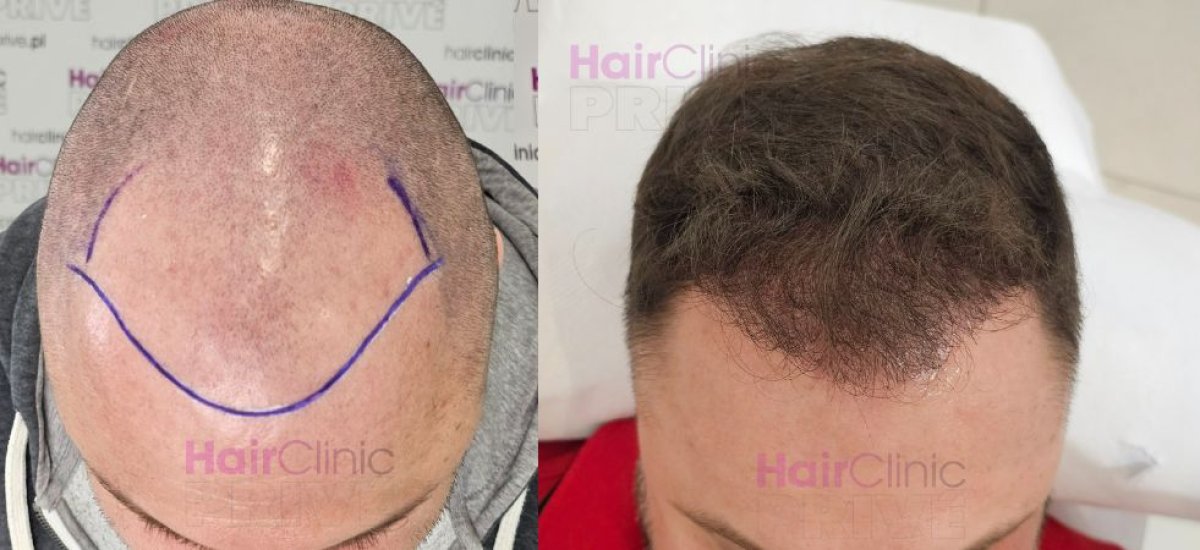 نتائج زراعة الشعر قبل وبعد في HairClinic – استعادة خط الشعر وكثافة فروة الرأس