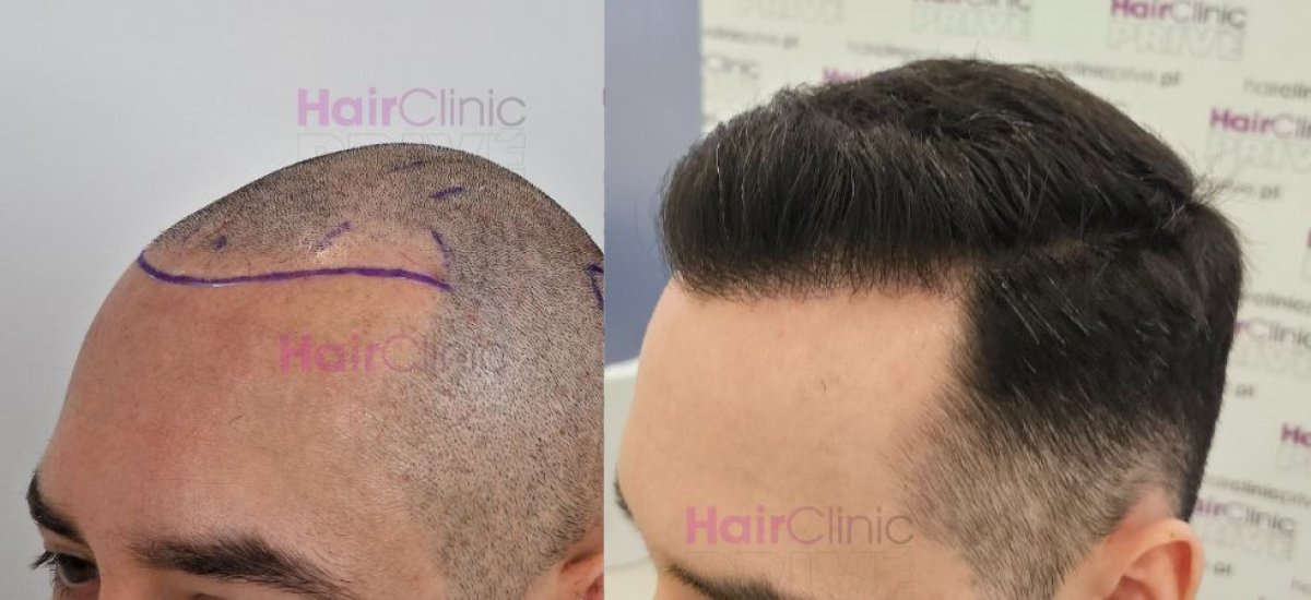 نتيجة زراعة الشعر قبل وبعد في HairClinic – استعادة خط الشعر الطبيعي لدى رجل