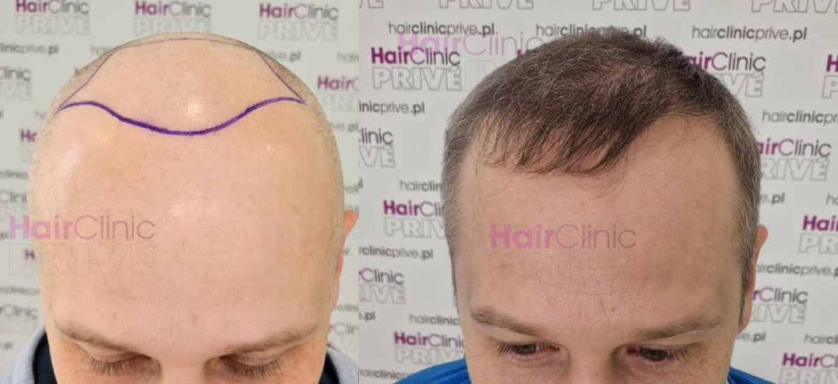 Resultados de trasplante capilar antes y después en HairClinic Prive – línea capilar restaurada