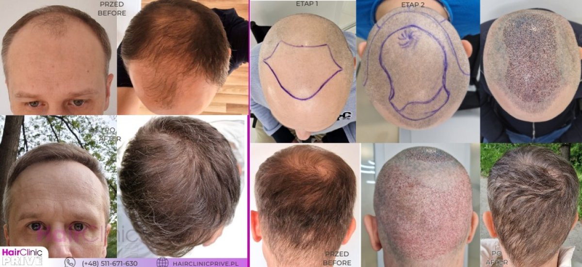 نتائج زراعة الشعر قبل وبعد في HairClinic Prive – استعادة خط وكثافة الشعر