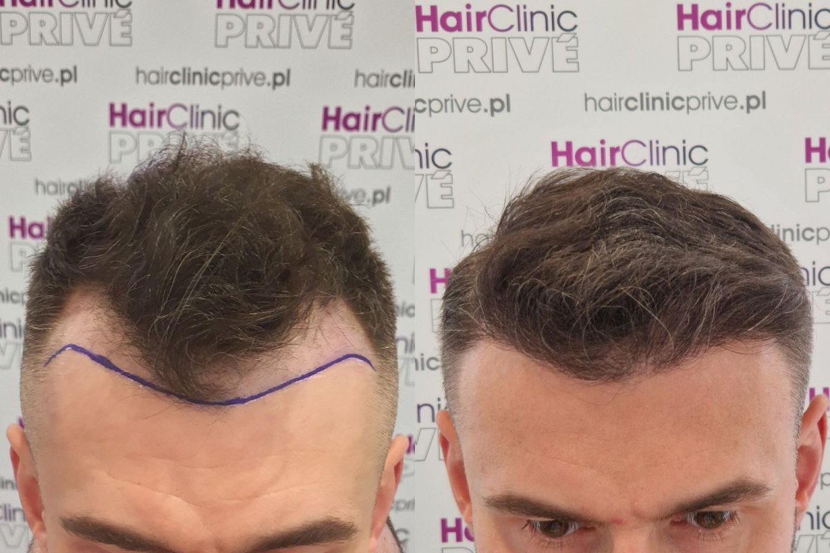 نتائج زراعة الشعر قبل وبعد في HairClinic Prive – استعادة خط الشعر الممتلئ