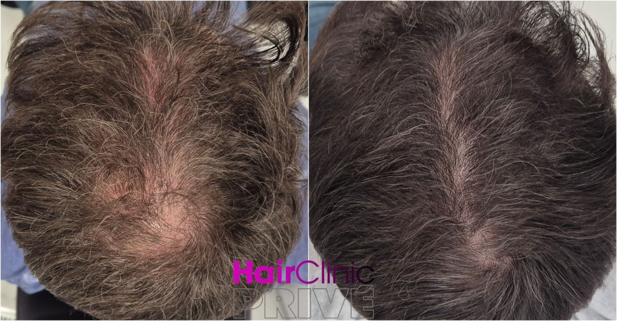 نتيجة زراعة الشعر قبل وبعد في HairClinic Prive – زيادة واضحة في كثافة الشعر