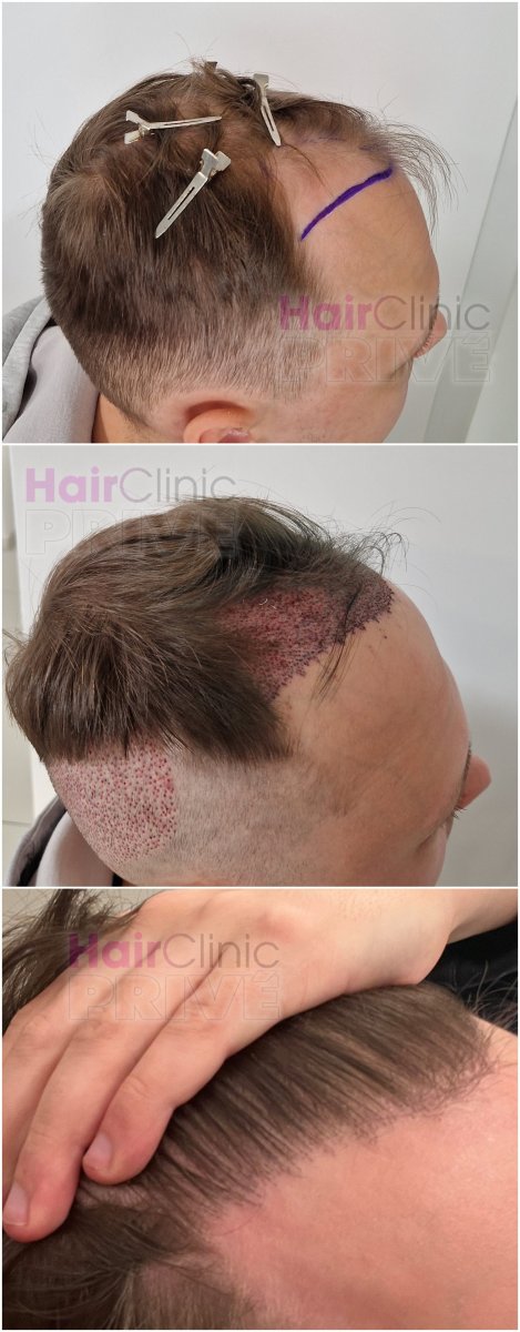 نتائج زراعة الشعر FUE قبل وبعد في Hair Clinic Prive – استعادة خط الشعر