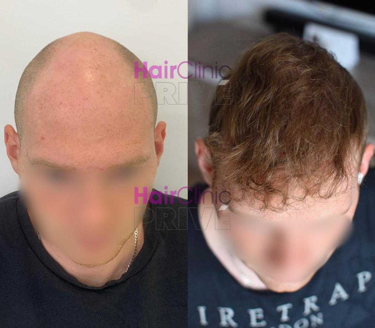 نتيجة زراعة الشعر قبل وبعد في HairClinic Prive – استعادة خط وكثافة الشعر