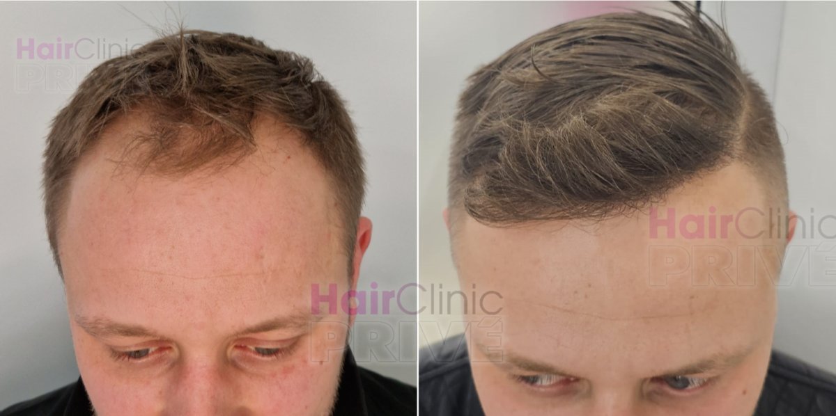 Resultados de trasplante capilar antes y después en Hair Clinic Prive – línea capilar restaurada