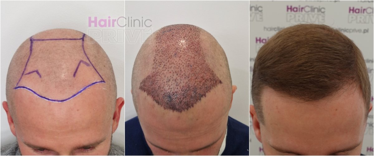 نتائج زراعة الشعر في HairClinic Prive – استعادة خط الشعر وكثافة الشعر