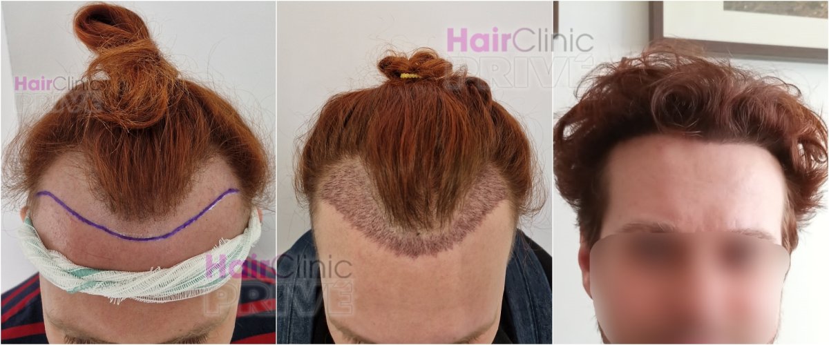 Resultados de trasplante capilar en Hair Clinic Prive: línea y densidad restauradas