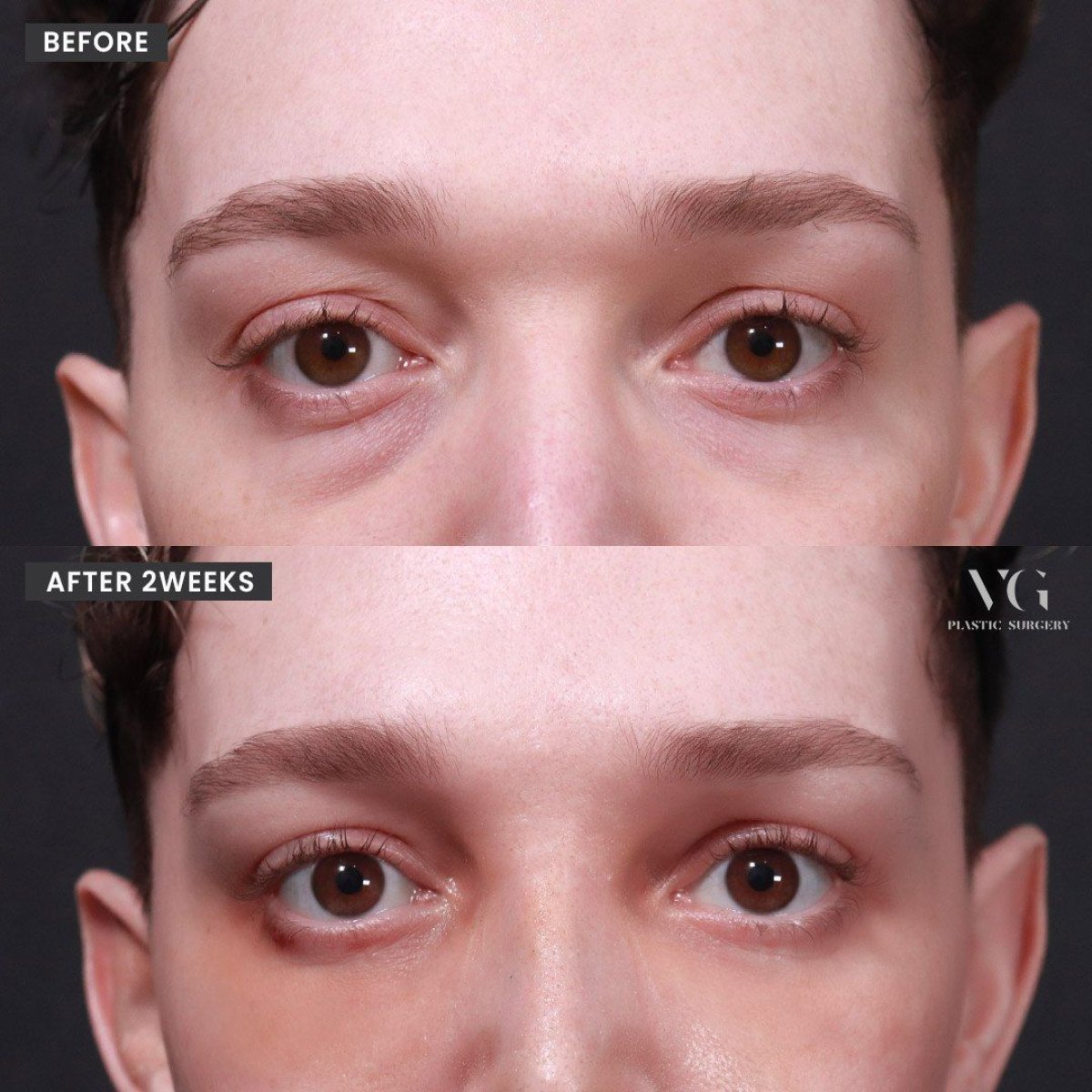 نتائج رأب الجفن السفلي قبل وبعد في VG Plastic Surgery، تقليل انتفاخ تحت العين