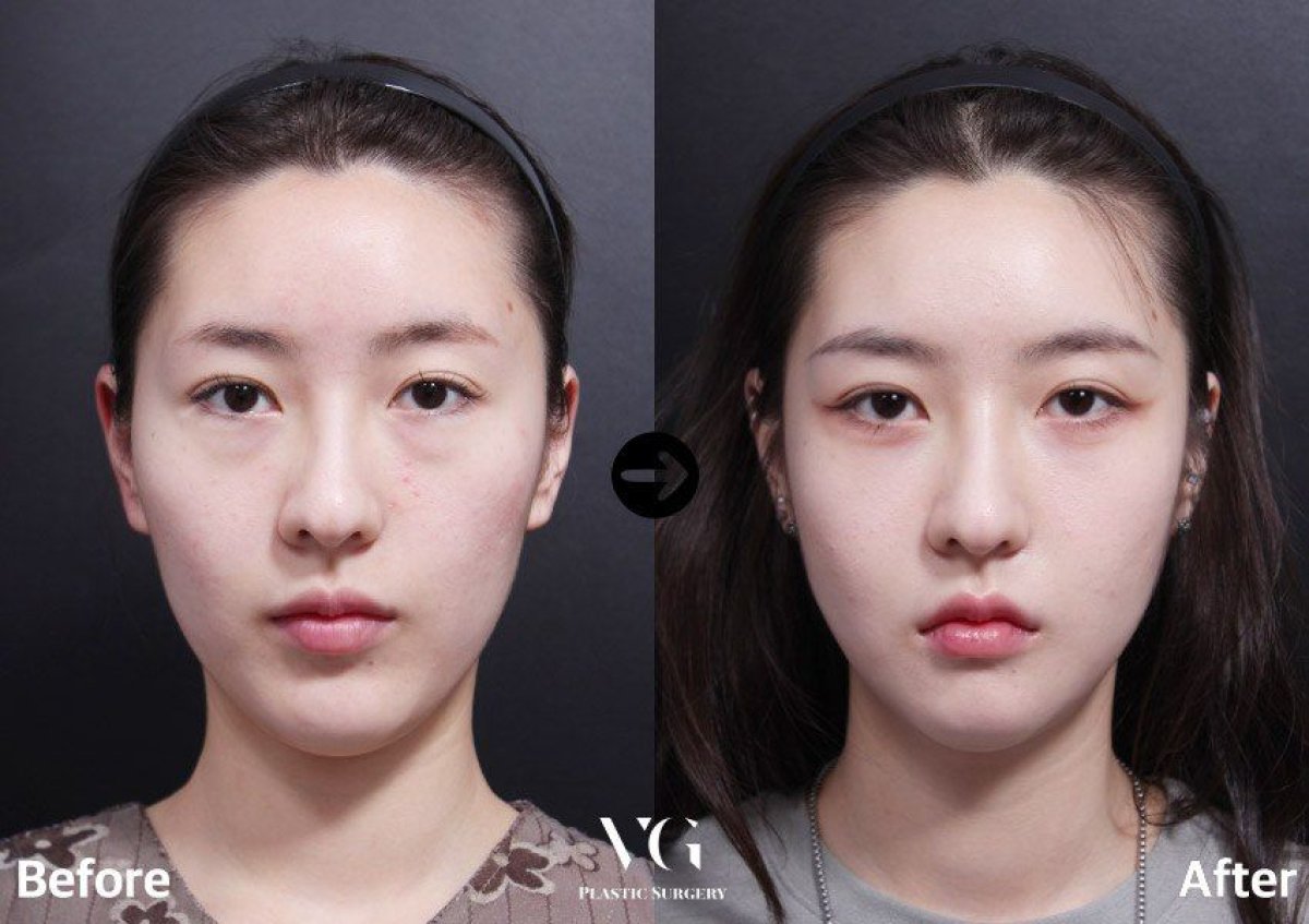 Результати нижньої блефаропластики до і після у VG Plastic Surgery, освіжена зона очей