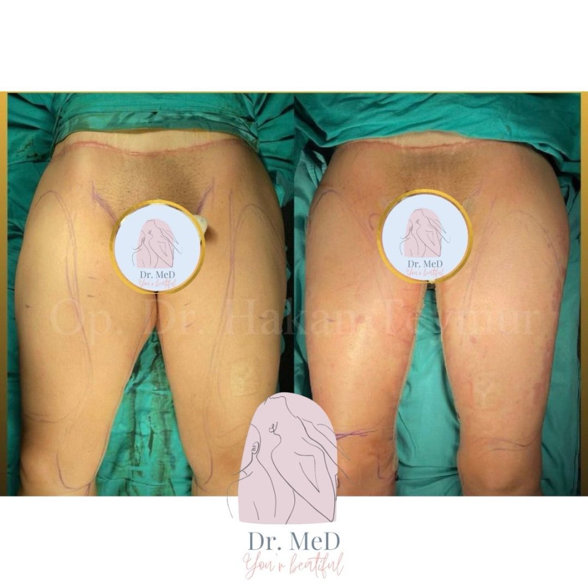 Resultados de liposucción antes y después en Dr. MED – mejor contorno de muslos y menos grasa
