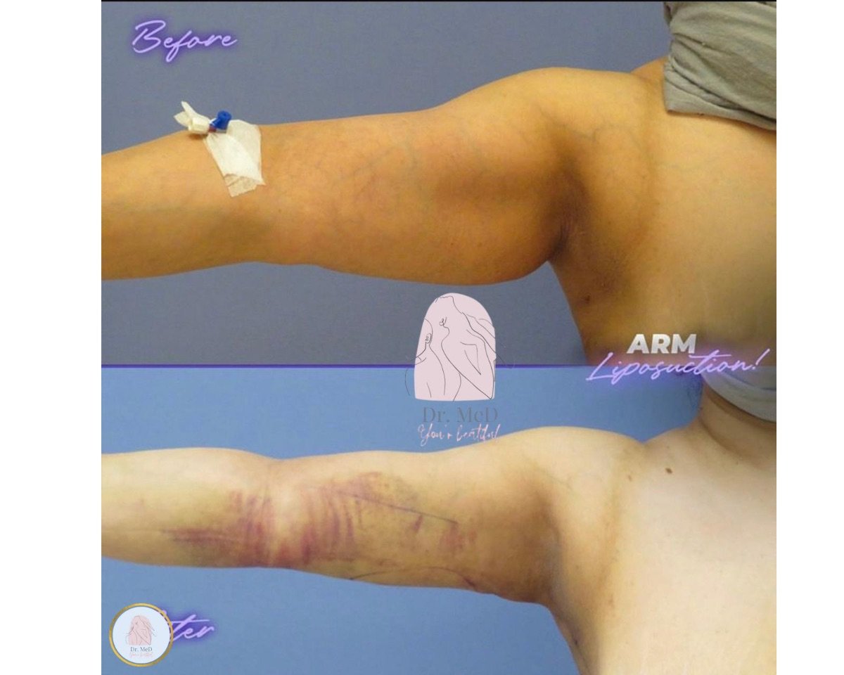 نتائج شفط دهون الذراع قبل وبعد في Dr. MED – تقليل الدهون وتحديد واضح