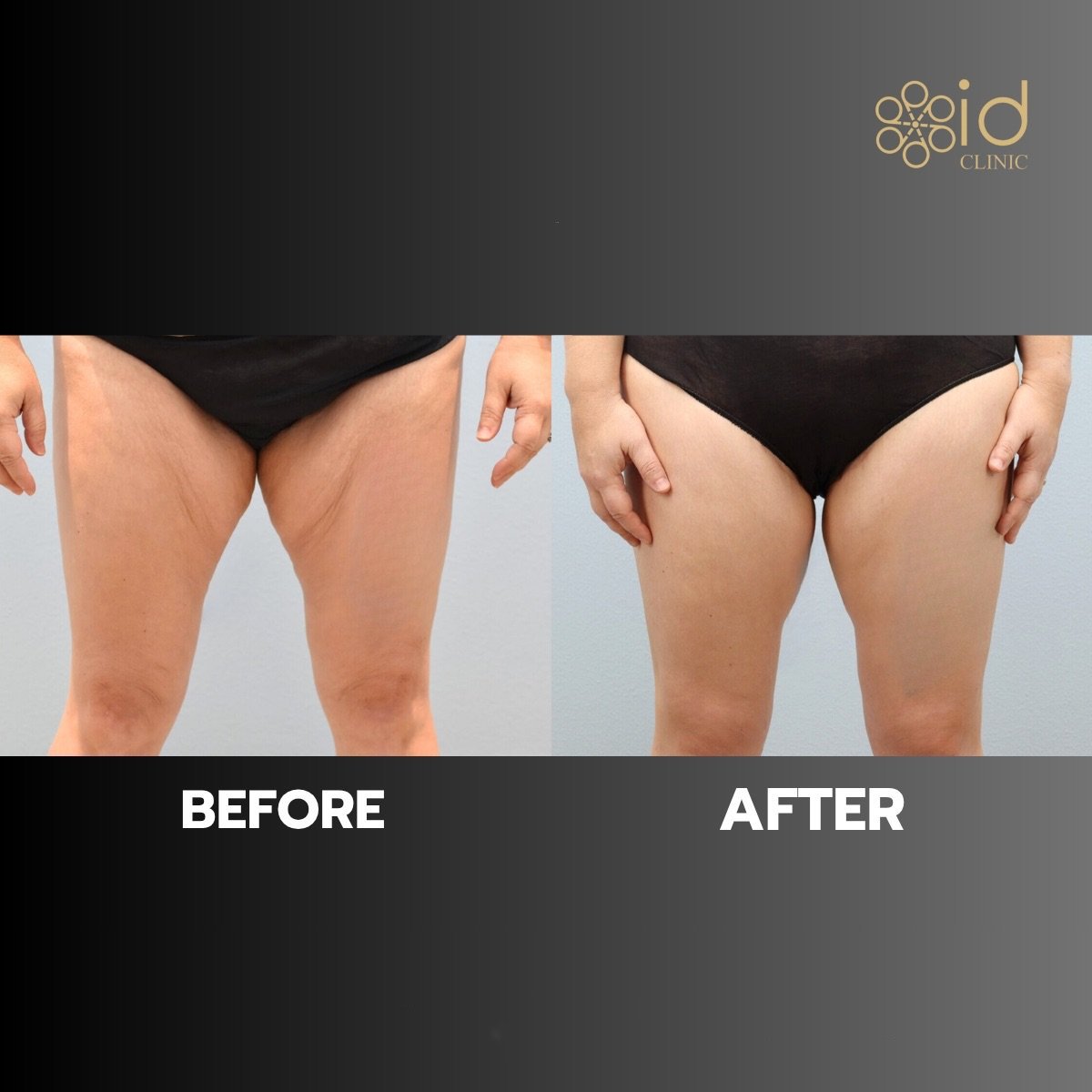 Before and after liposuction results at ID Clinic Bangkok, improved thigh contour and firmness