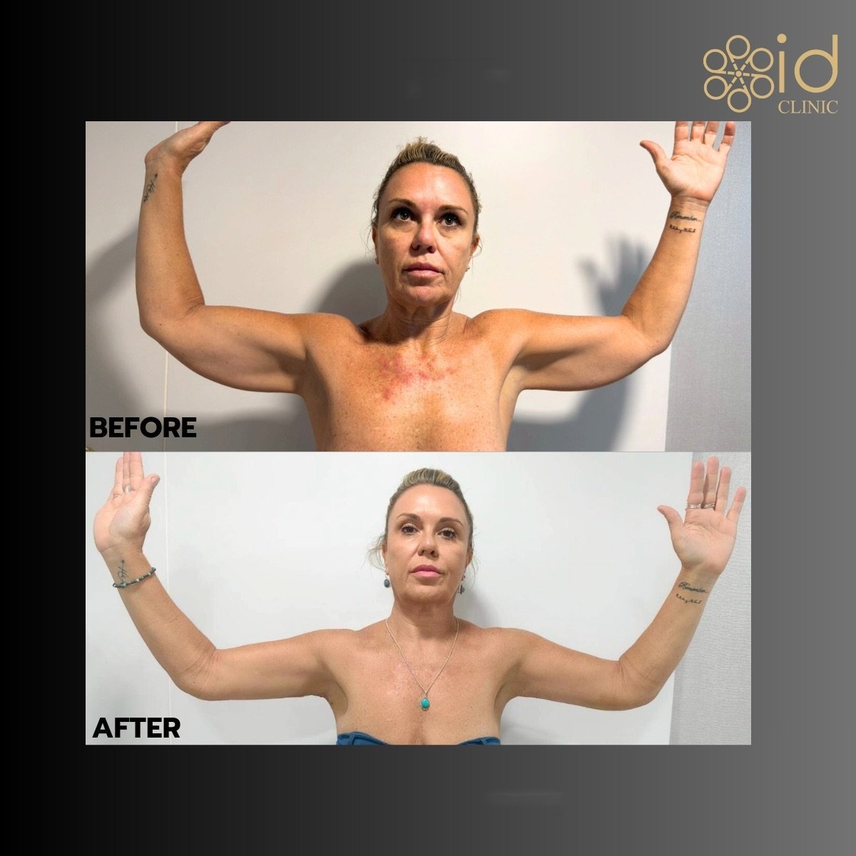 نتائج شفط الدهون قبل وبعد في ID Clinic Bangkok، تحسين تحديد وشكل الذراعين