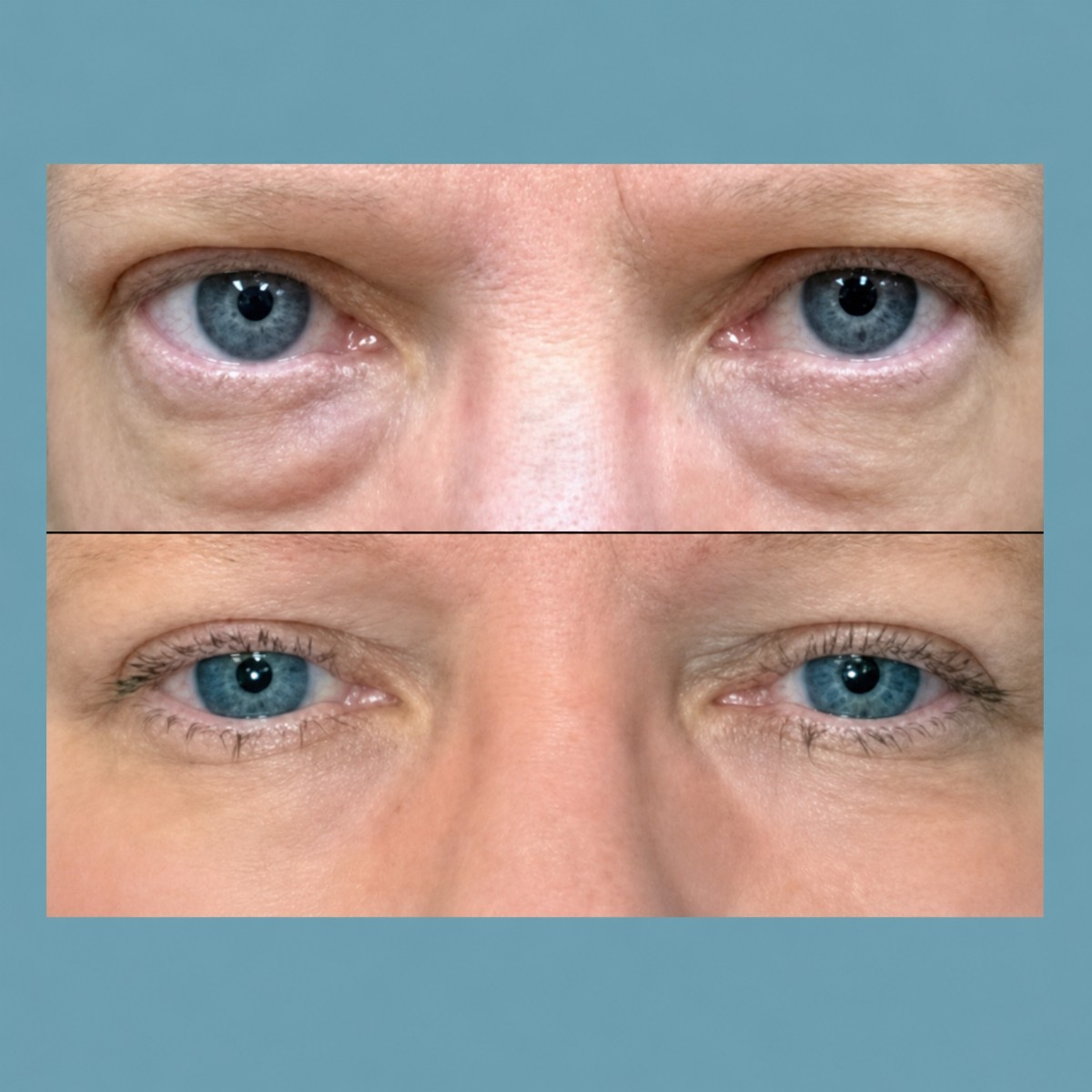 Before and after upper and lower eyelid surgery results at ID Clinic Bangkok, rejuvenated eyes
