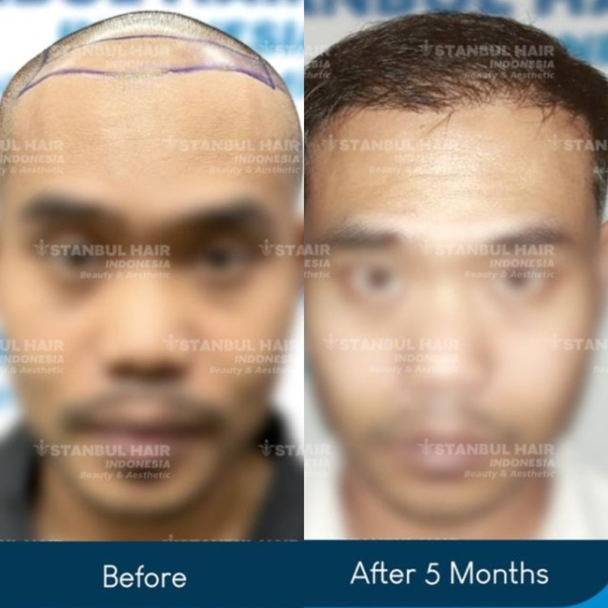 نتيجة زراعة الشعر FUE قبل وبعد 5 أشهر في عيادة إسطنبول هير إندونيسيا