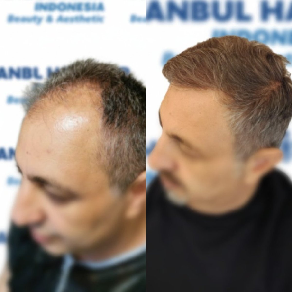 Resultado antes y después de trasplante capilar DHI en Istanbul Hair Indonesia, línea restaurada