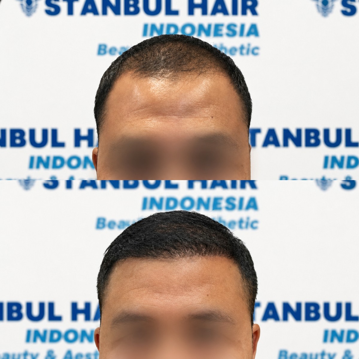 Результаты до и после DHI пересадки волос в Istanbul Hair Indonesia, улучшенная линия роста