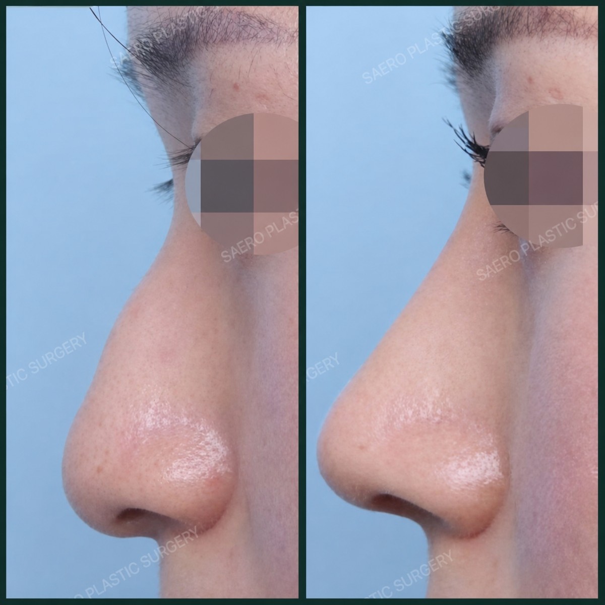 Résultats avant/après retrait bosse nasale chez SAERO Plastic Surgery, profil lissé