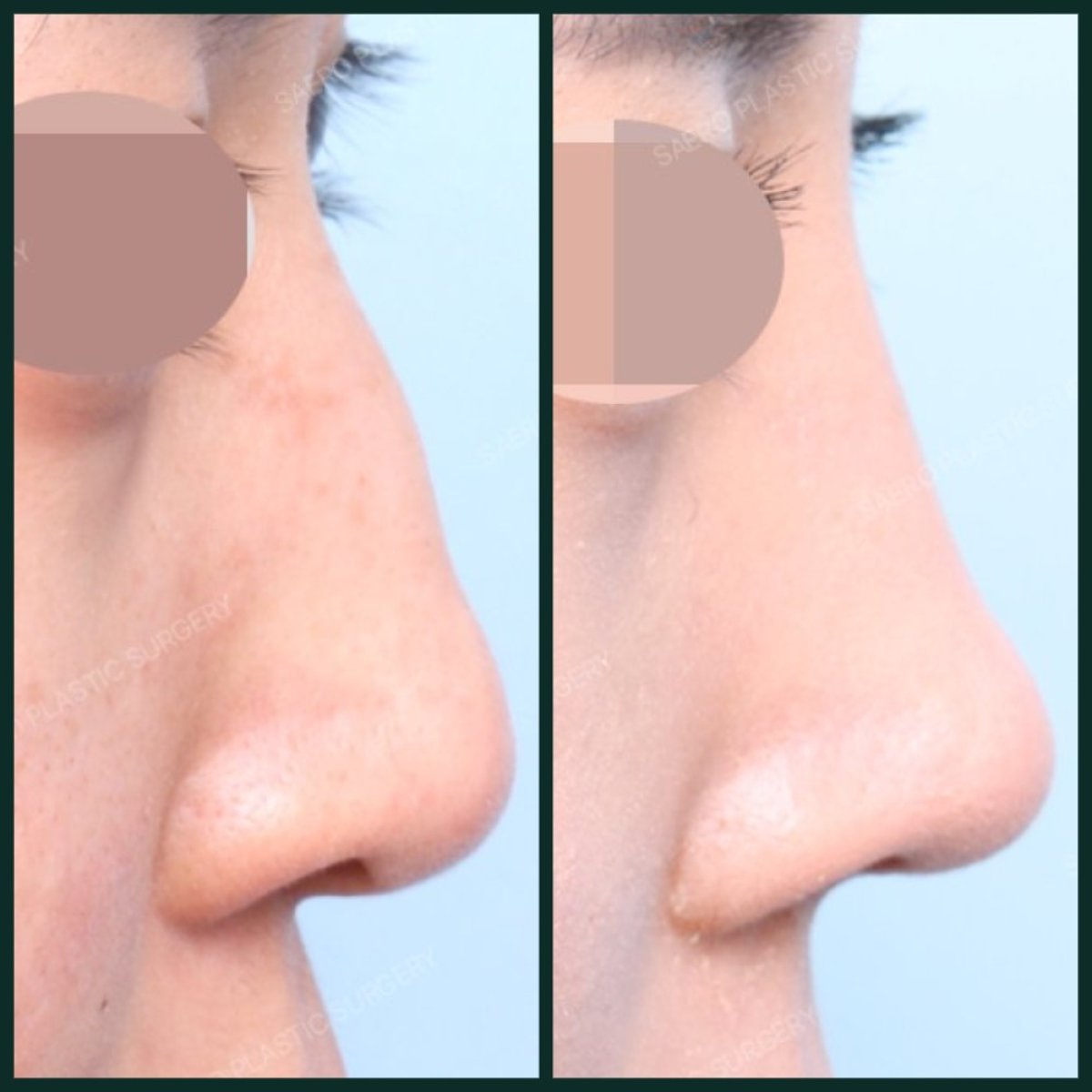 Результати до і після видалення горбинки носа в SAERO Plastic Surgery, рівний профіль