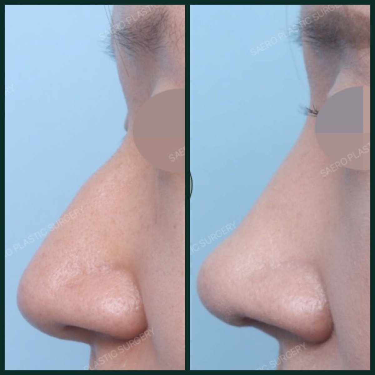 Результати до і після видалення горбинки носа в SAERO Plastic Surgery, рівний профіль