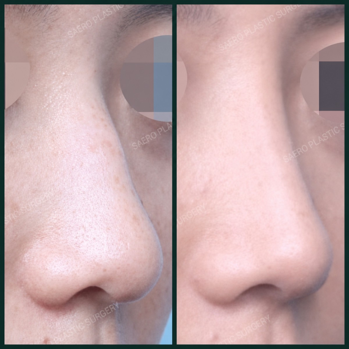 Before and after nasal hump removal results at SAERO Plastic Surgery, smoother nose profile