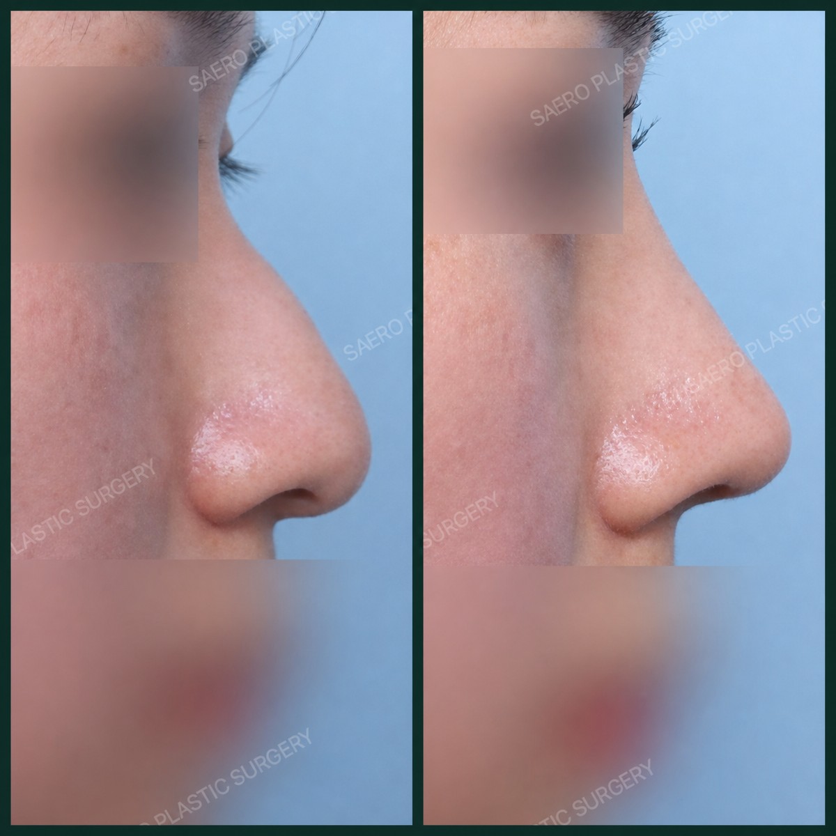 نتائج قبل وبعد إزالة حدبة الأنف في SAERO Plastic Surgery، تحسين شكل الأنف الجانبي
