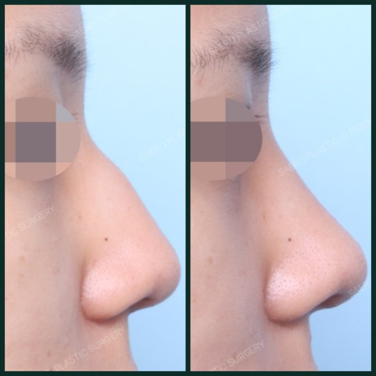 До і після видалення горбинки носа в SAERO Plastic Surgery, результат ринопластики збоку