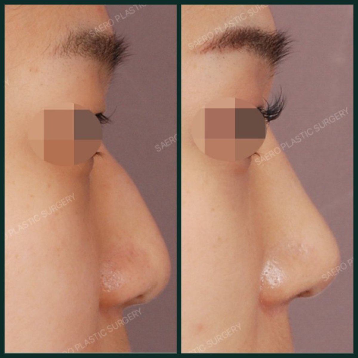قبل وبعد إزالة حدبة الأنف في SAERO Plastic Surgery، نتيجة أنف أكثر نعومة