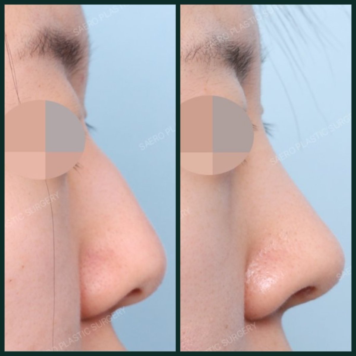 Before and after nasal hump removal results at SAERO Plastic Surgery, smoother nose profile