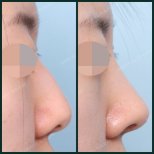 Ergebnisse der Rhinoplastik (Nasenkorrektur) durch Dr. — Vorher- und Nachher-Fotos des Patienten Fotos vor und nach Rhinoplastik (Nasenkorrektur) durch Dr.