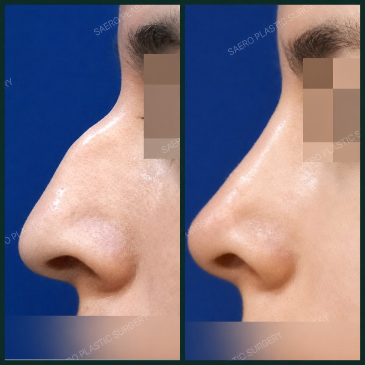 نتائج قبل وبعد إزالة حدبة الأنف في SAERO Plastic Surgery، مظهر أنف أكثر نعومة
