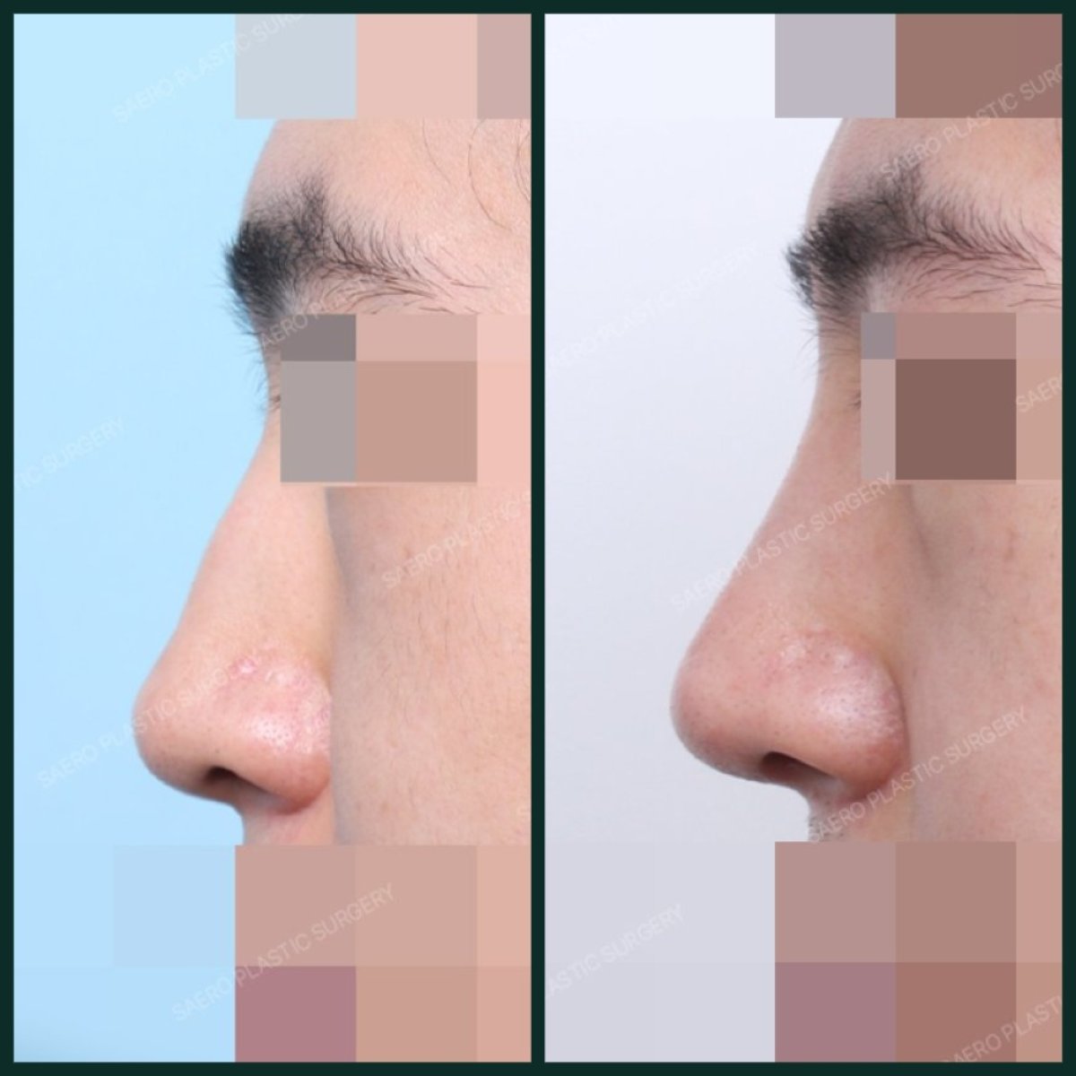 Resultados antes y después de eliminación de giba nasal en SAERO Plastic Surgery, perfil mejorado