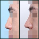 Ergebnisse der Rhinoplastik (Nasenkorrektur) durch Dr. — Vorher- und Nachher-Fotos des Patienten Fotos vor und nach Rhinoplastik (Nasenkorrektur) durch Dr.