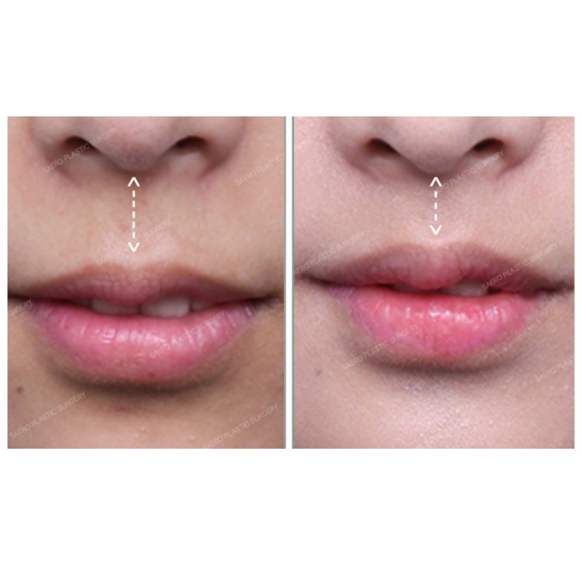 Before and after lip lift results at SAERO Plastic Surgery – enhanced upper lip contour
