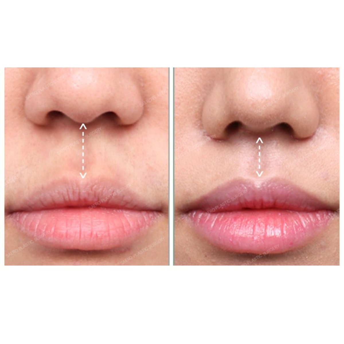 Vorher-nachher-Ergebnis Lip Lift bei SAERO Plastic Surgery, verbesserte Lippenkontur