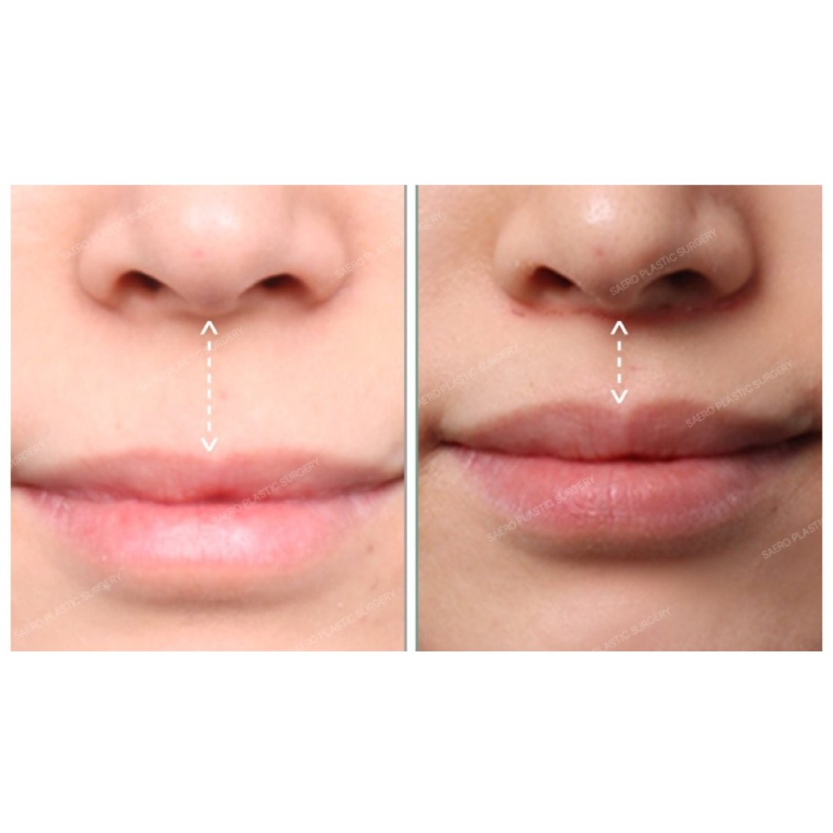 Resultados de antes y después de lip lift en SAERO Plastic Surgery, mejor contorno labial