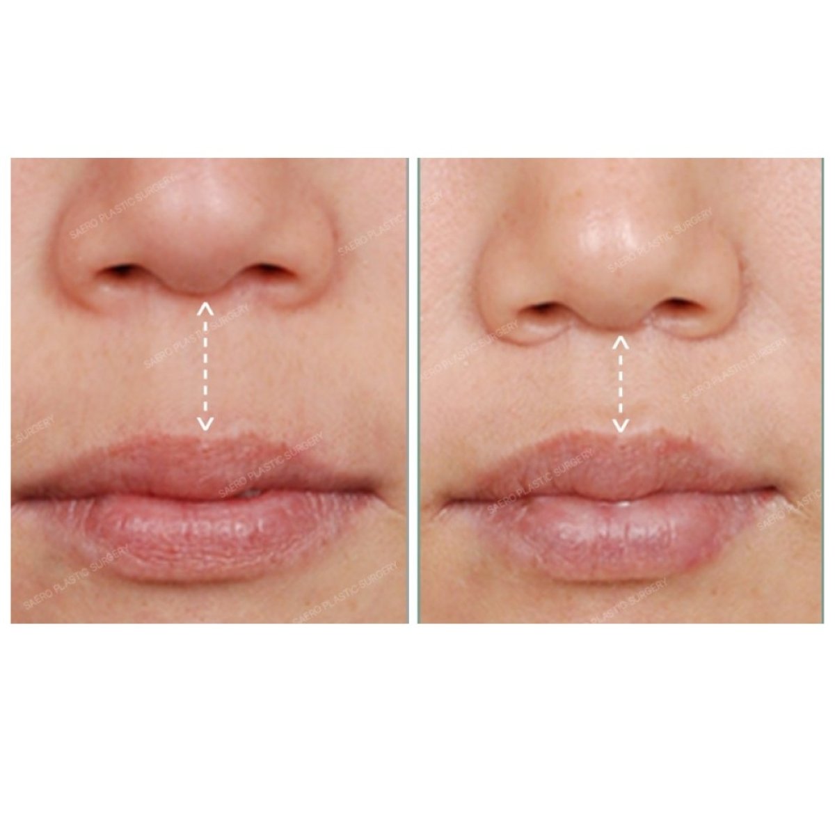 Vorher-nachher-Ergebnis Lip Lift bei SAERO Plastic Surgery, verbesserte Lippenkontur