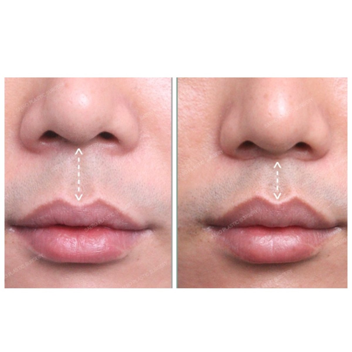 Resultados antes y después de lip lift en SAERO Plastic Surgery, mejor contorno labial