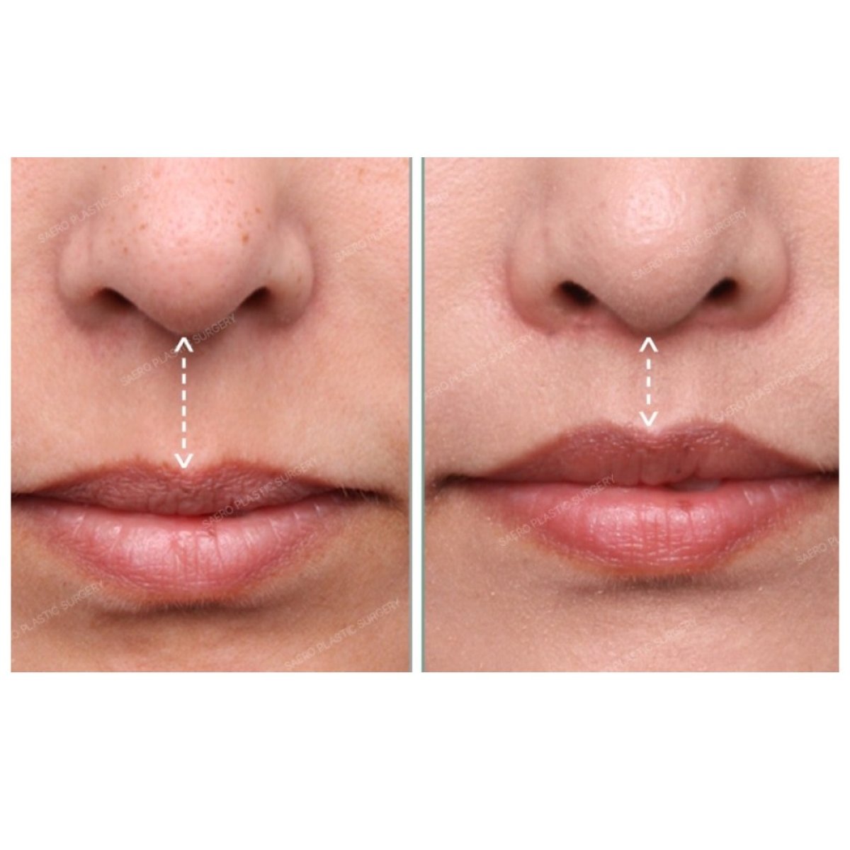 Результати до і після липліфтингу в SAERO Plastic Surgery – покращений контур верхньої губи