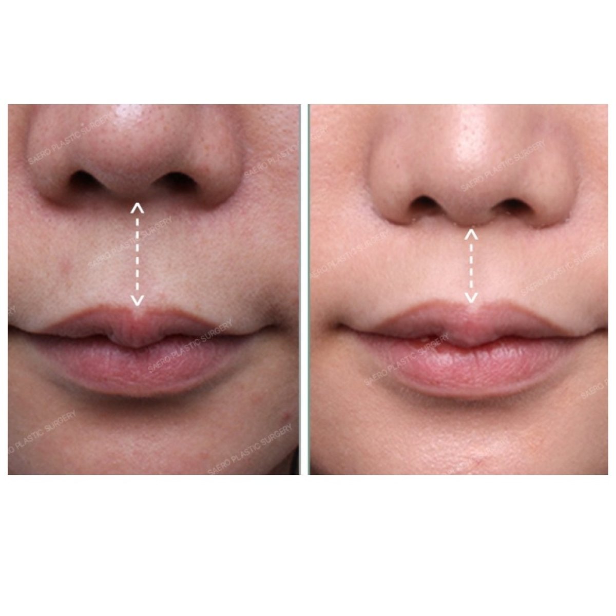 Résultats avant/après lip lift chez SAERO Plastic Surgery, contour des lèvres amélioré