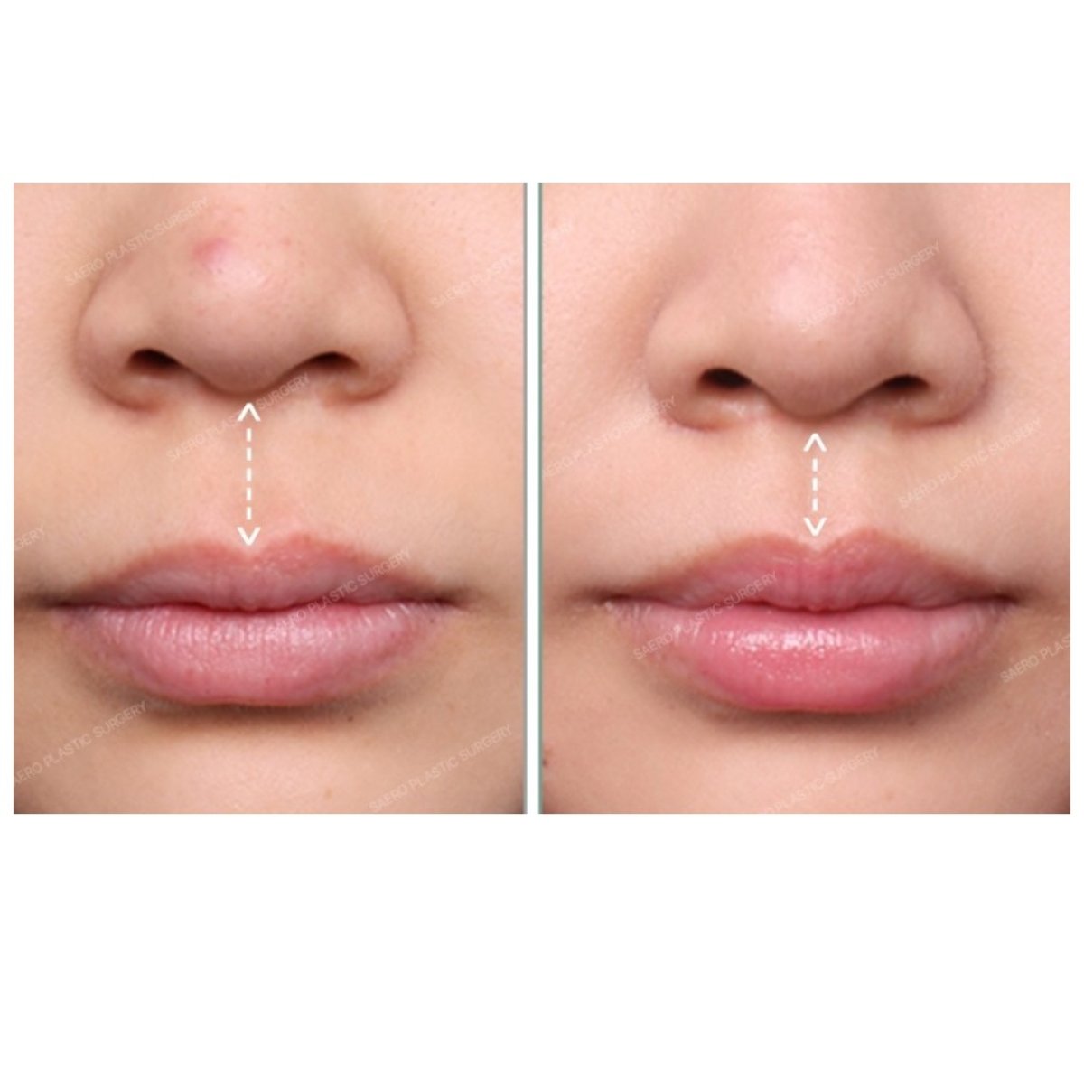Before and after lip lift results at SAERO Plastic Surgery, improved upper lip contour